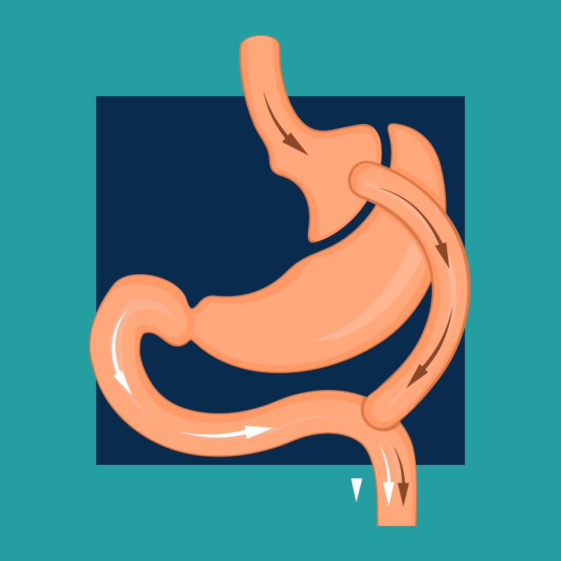 Gastric bypass surgery - Dr wael shalaan best obesity surgery