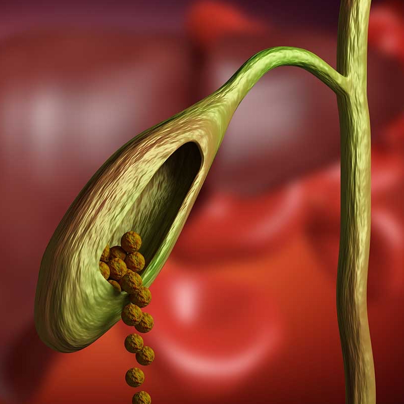 gallbladder stones surgery -  general surgery
